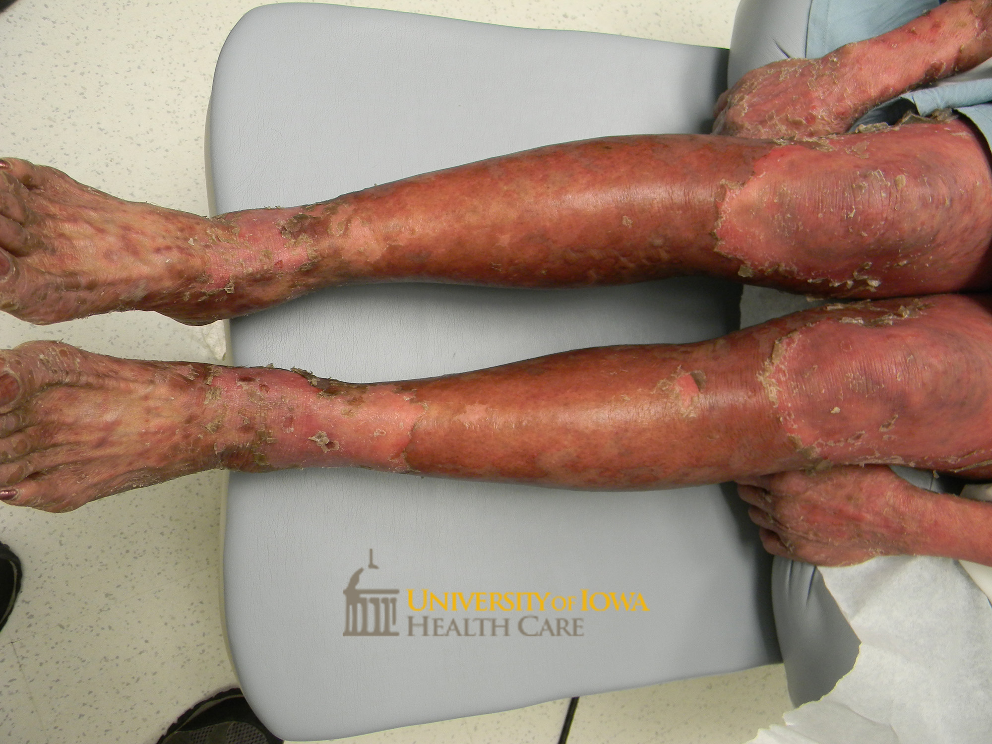 Superficial erosisons with collarette of scale and surrounding erythema on th elegs and arms. (click images for higher resolution).